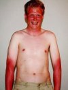 Sunburn.jpg