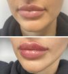 Lip-plumping-at-skin-tightening-botox-and-lip-fillers-by-skinsation-la.jpg